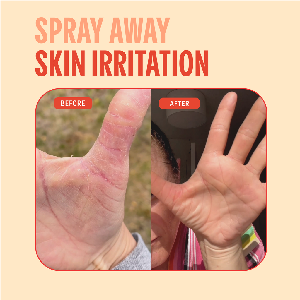 Mighty Mist Clear Skin Spray | Hypochlorous Acid Facial Spray for Acne, Eczema, Rosacea