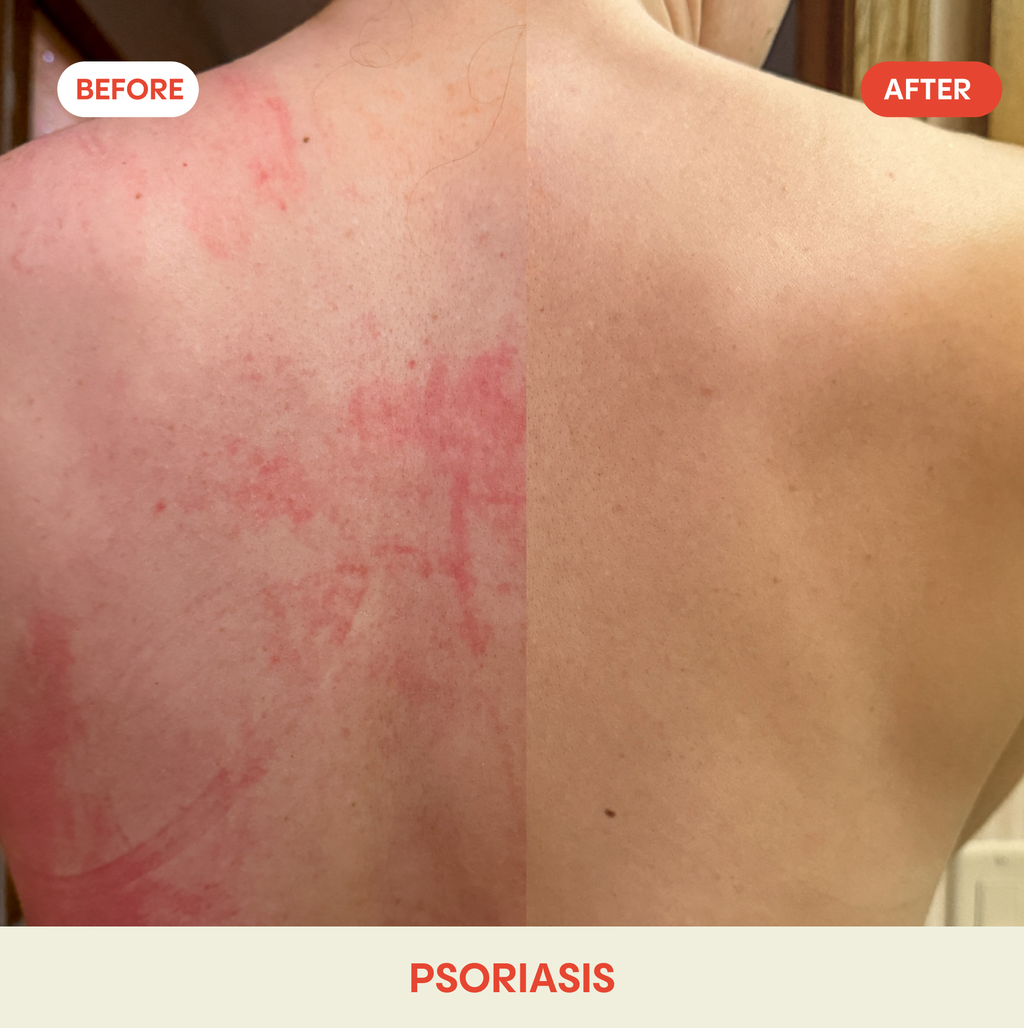Mighty Mist Clear Skin Spray | Hypochlorous Acid Facial Spray for Acne, Eczema, Rosacea
